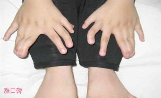 盘点世界最多 印度小男孩竟有14个手指和20个脚趾